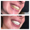 BrightSmile Pro Teeth Whitening Kit